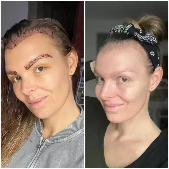 Transplantace vlasů