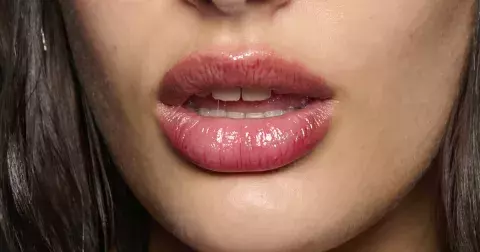 Migrace výplní: strašák estetické medicíny, kterého však lze zahnat